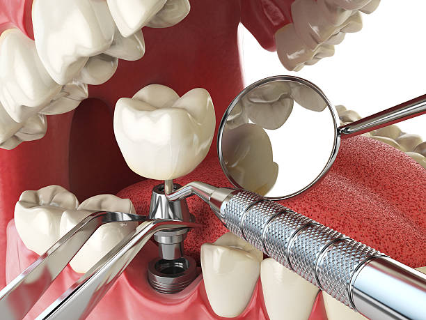 Best Emergency Dental Care for Broken or Chipped Teeth in Oak Harbor, OH